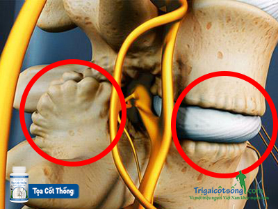 bệnh gai côt không nên ăn gì